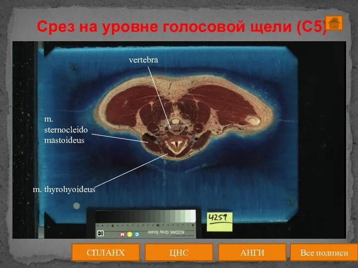 Срез на уровне голосовой щели (C5) ЦНС АНГИ СПЛАНХ Все подписи