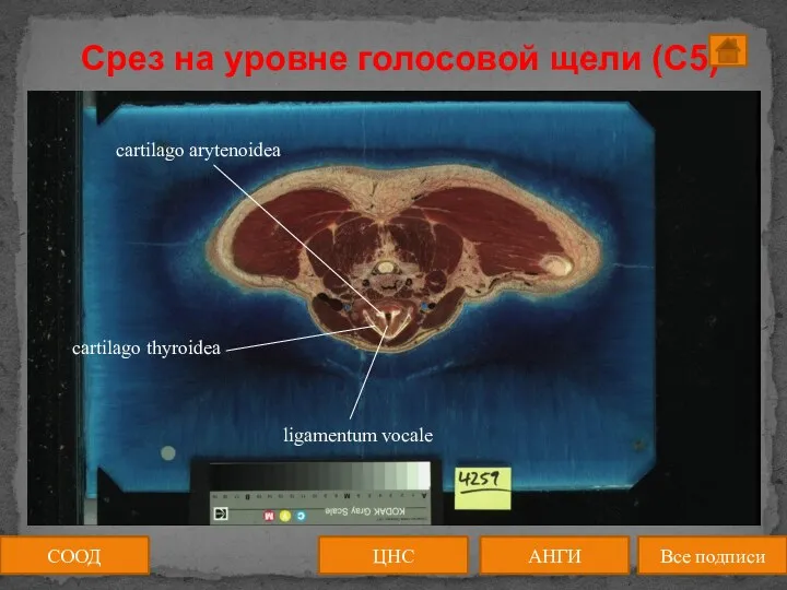 Срез на уровне голосовой щели (C5) СООД ЦНС АНГИ Все подписи