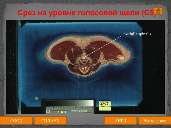 Срез на уровне голосовой щели (C5) СООД АНГИ СПЛАНХ Все подписи