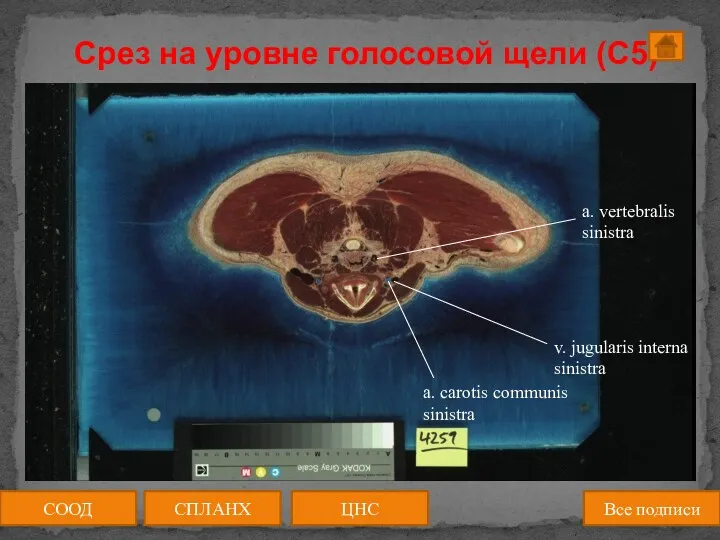 Срез на уровне голосовой щели (C5) СООД ЦНС СПЛАНХ Все подписи