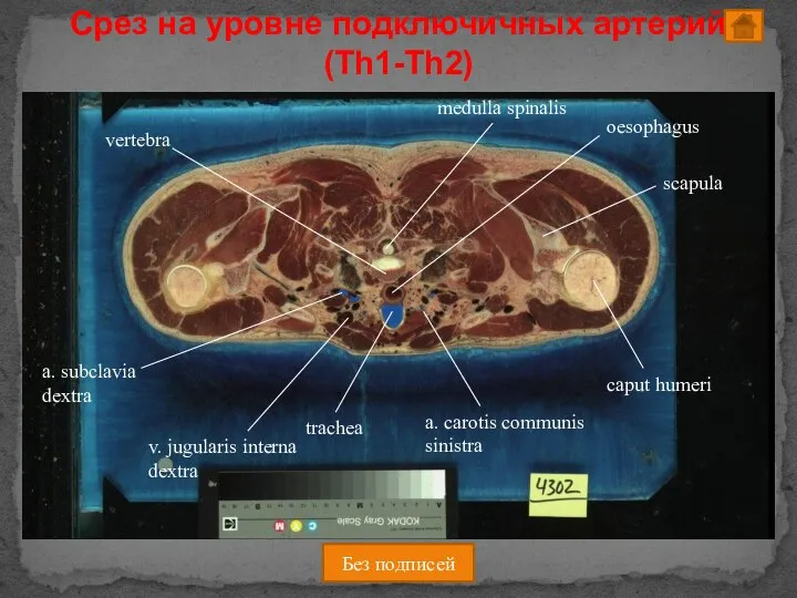 Срез на уровне подключичных артерий (Th1-Th2) Без подписей