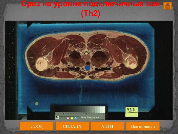 Срез на уровне подключичных вен (Th2) СООД АНГИ СПЛАНХ Все подписи