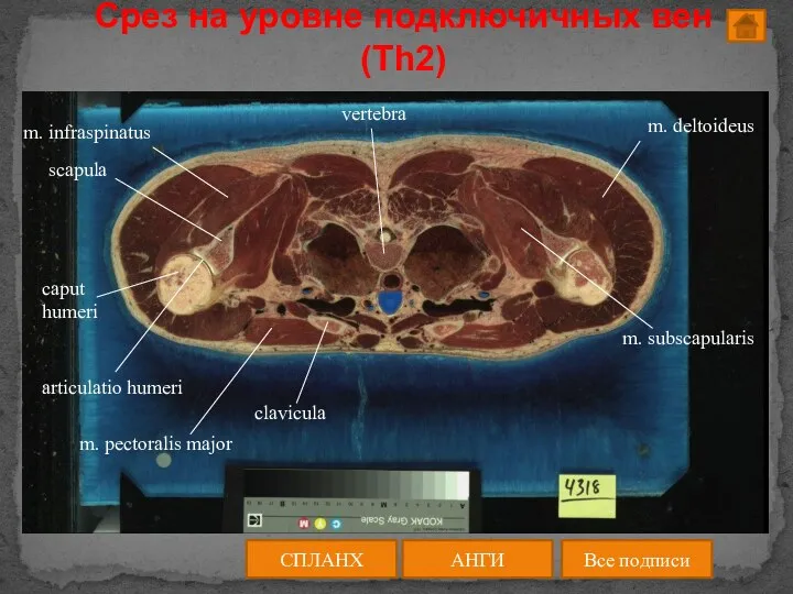 Срез на уровне подключичных вен (Th2) АНГИ СПЛАНХ Все подписи