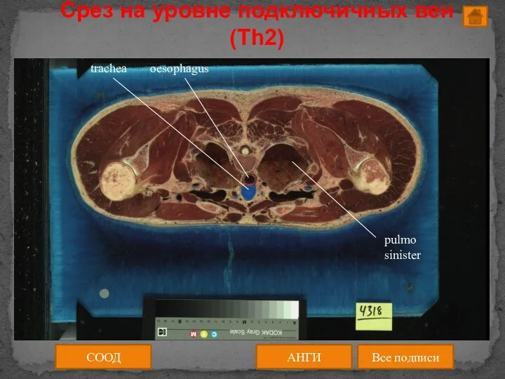 Срез на уровне подключичных вен (Th2) СООД АНГИ Все подписи