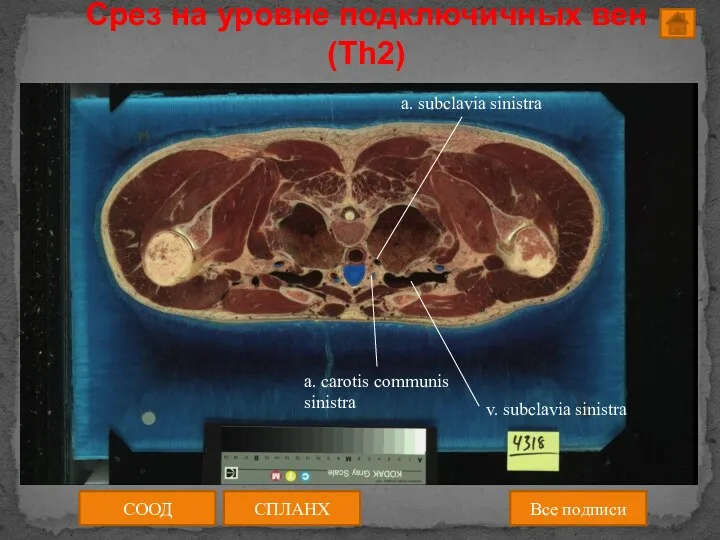 Срез на уровне подключичных вен (Th2) СООД СПЛАНХ Все подписи