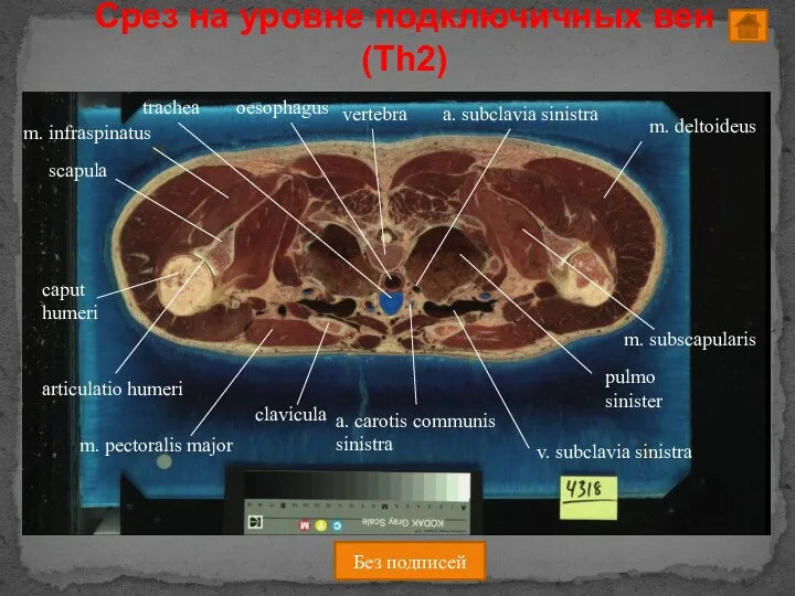 Срез на уровне подключичных вен (Th2) Без подписей