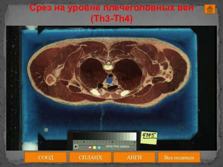 Срез на уровне плечеголовных вен (Th3-Th4) СООД АНГИ СПЛАНХ Все подписи