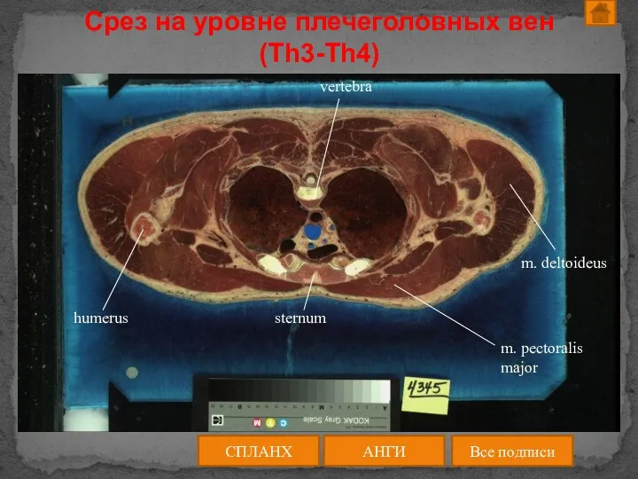 АНГИ СПЛАНХ Все подписи Срез на уровне плечеголовных вен (Th3-Th4)