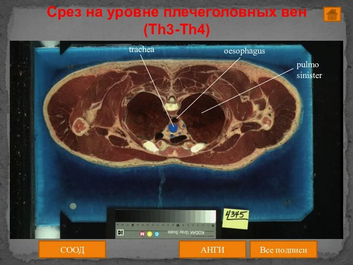 СООД АНГИ Все подписи Срез на уровне плечеголовных вен (Th3-Th4)