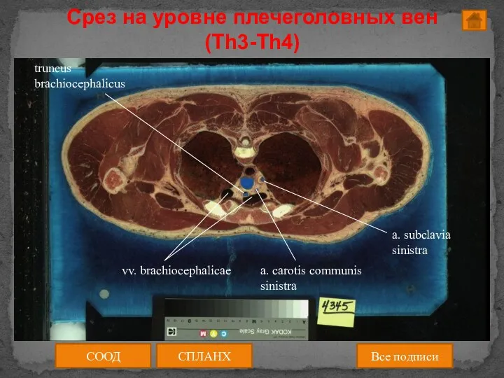 СООД СПЛАНХ Все подписи Срез на уровне плечеголовных вен (Th3-Th4)