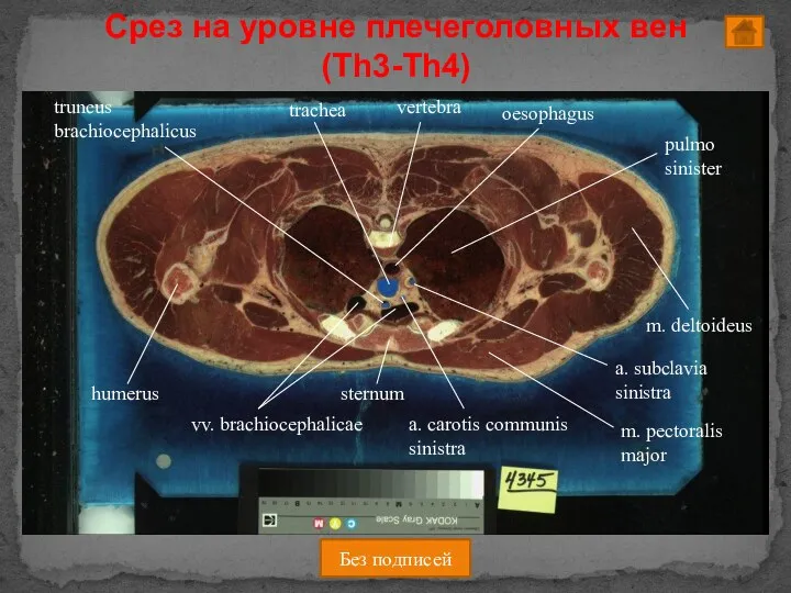 Без подписей Срез на уровне плечеголовных вен (Th3-Th4)