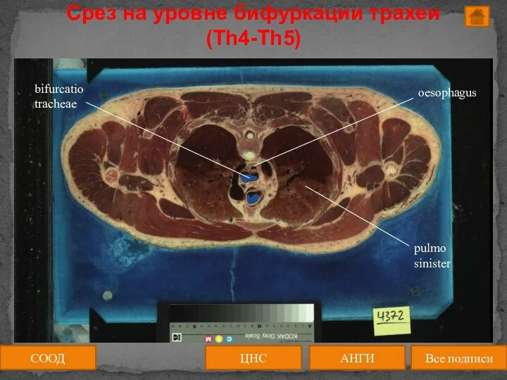 ЦНС АНГИ Все подписи СООД Срез на уровне бифуркации трахеи (Th4-Th5)