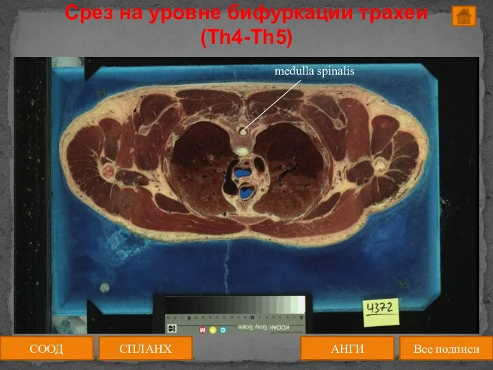 АНГИ СПЛАНХ Все подписи СООД Срез на уровне бифуркации трахеи (Th4-Th5)