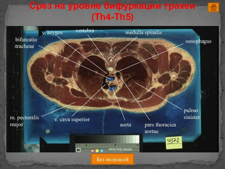 Без подписей Срез на уровне бифуркации трахеи (Th4-Th5)