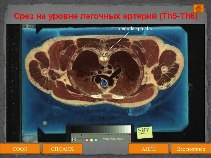 Срез на уровне легочных артерий (Th5-Th6) СООД АНГИ СПЛАНХ Все подписи