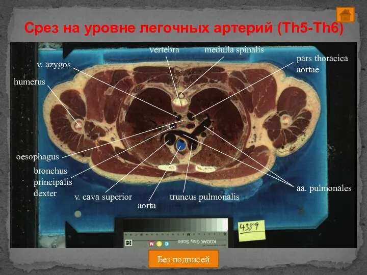 Срез на уровне легочных артерий (Th5-Th6) Без подписей