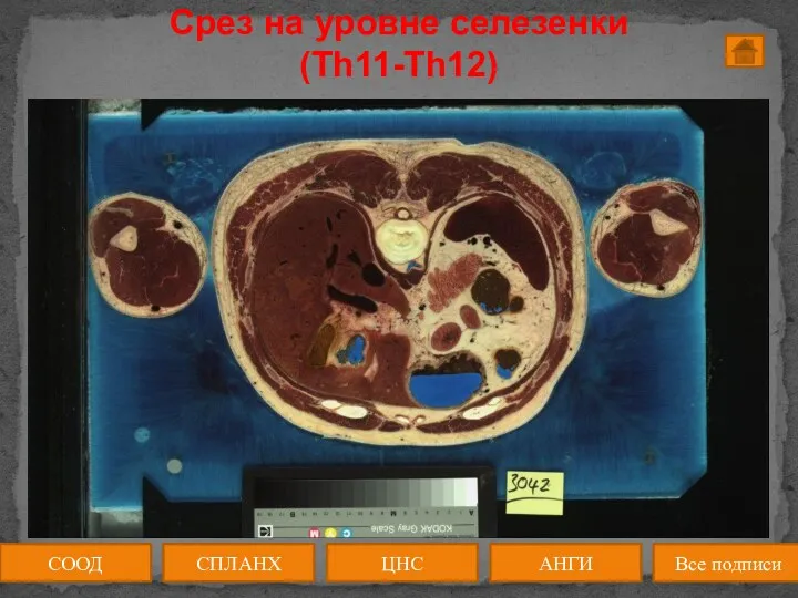 Срез на уровне селезенки (Th11-Th12) СООД АНГИ СПЛАНХ Все подписи ЦНС