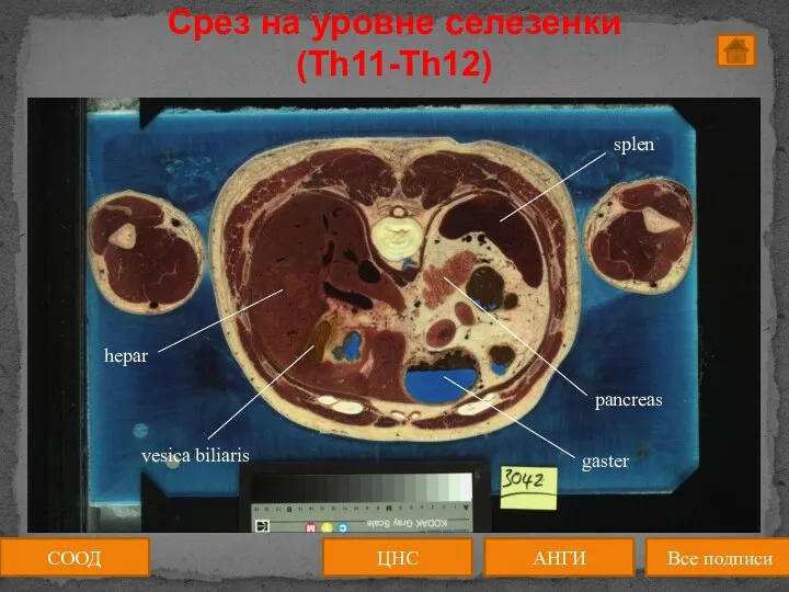 СООД АНГИ Все подписи ЦНС Срез на уровне селезенки (Th11-Th12)