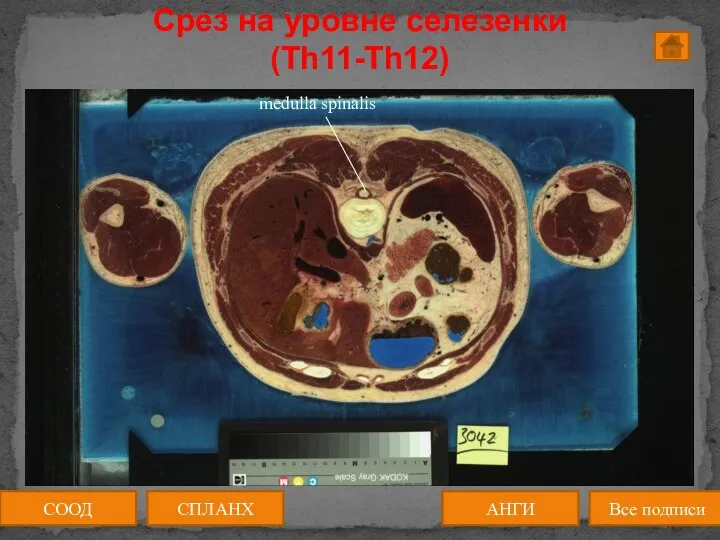 СООД АНГИ СПЛАНХ Все подписи Срез на уровне селезенки (Th11-Th12)