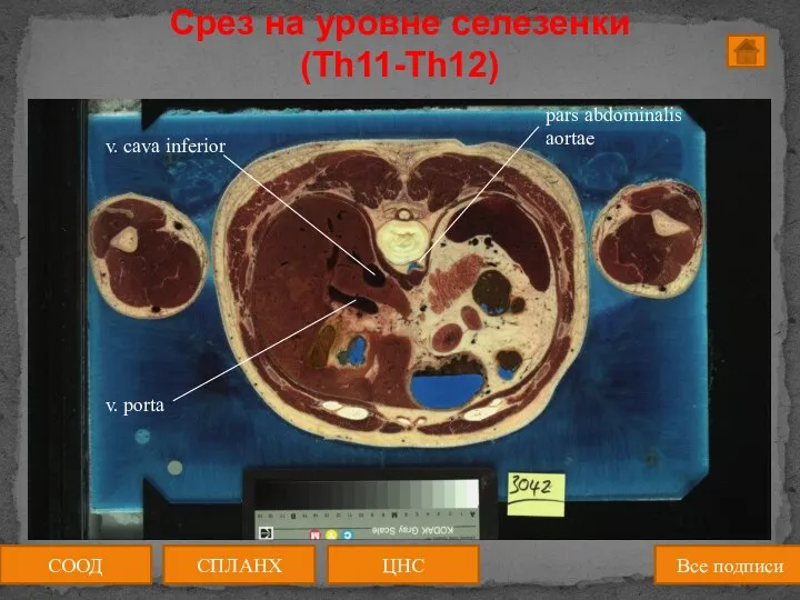 СООД СПЛАНХ Все подписи ЦНС Срез на уровне селезенки (Th11-Th12)