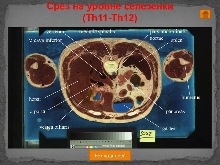 Без подписей Срез на уровне селезенки (Th11-Th12)