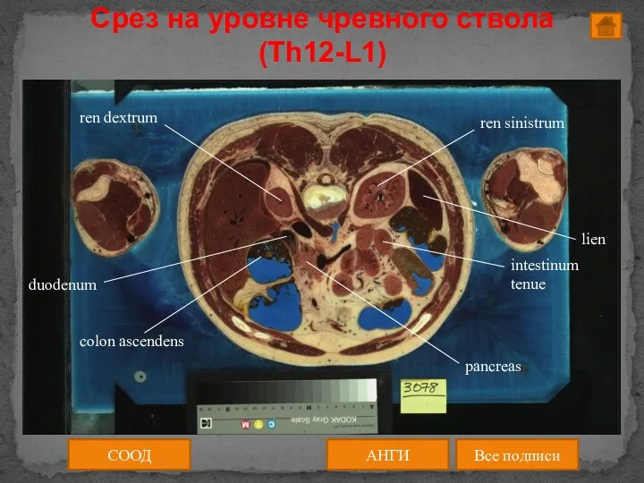 Срез на уровне чревного ствола (Th12-L1) АНГИ Все подписи СООД