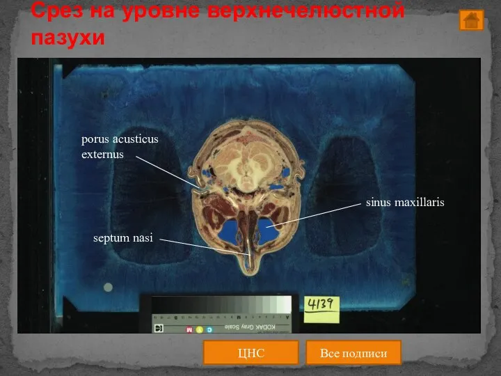 ЦНС Все подписи Срез на уровне верхнечелюстной пазухи