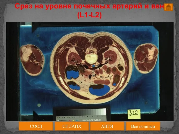 Срез на уровне почечных артерий и вен (L1-L2) АНГИ СПЛАНХ Все подписи СООД