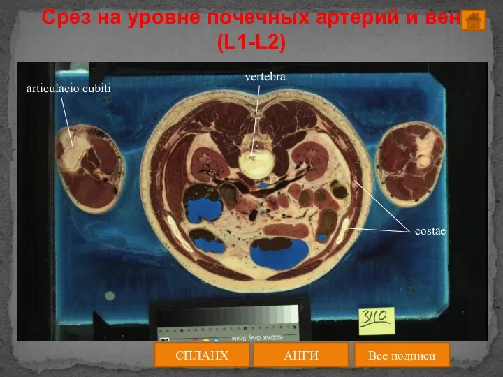 Срез на уровне почечных артерий и вен (L1-L2) АНГИ СПЛАНХ Все подписи