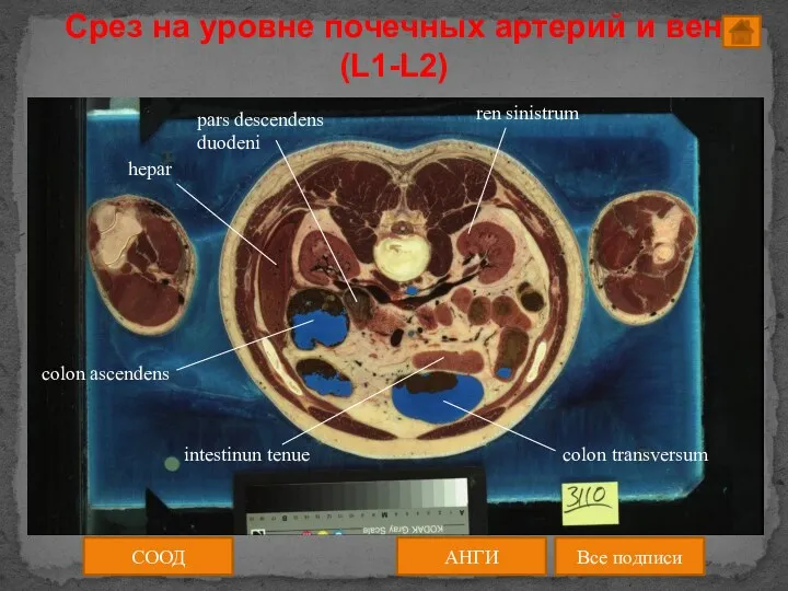 Срез на уровне почечных артерий и вен (L1-L2) АНГИ Все подписи СООД