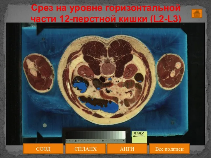 Срез на уровне горизонтальной части 12-перстной кишки (L2-L3) СООД АНГИ СПЛАНХ Все подписи