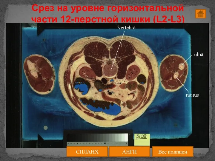 Срез на уровне горизонтальной части 12-перстной кишки (L2-L3) АНГИ СПЛАНХ Все подписи