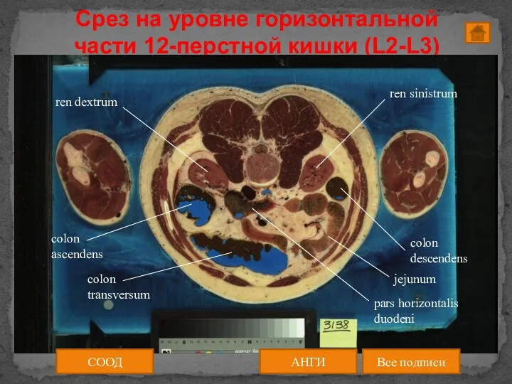 Срез на уровне горизонтальной части 12-перстной кишки (L2-L3) СООД АНГИ Все подписи