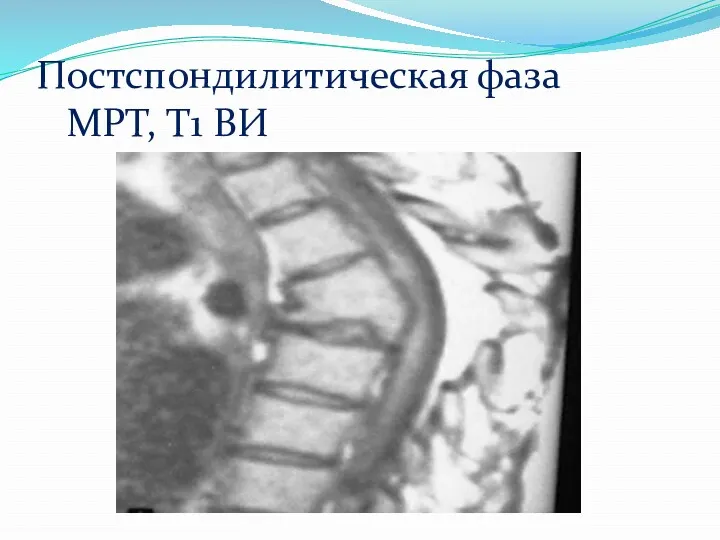 Постспондилитическая фаза МРТ, Т1 ВИ