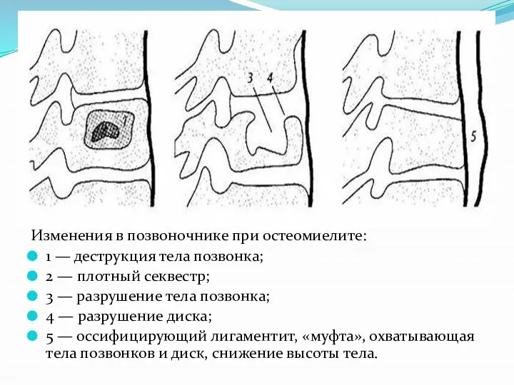 Изменения в позвоночнике при остеомиелите: 1 — деструкция тела позвонка;