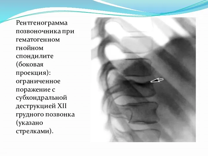 Рентгенограмма позвоночника при гематогенном гнойном спондилите (боковая проекция): ограниченное поражение