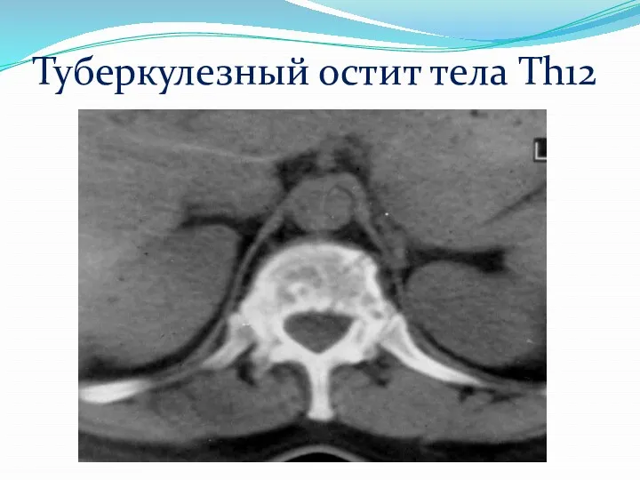 Туберкулезный остит тела Th12