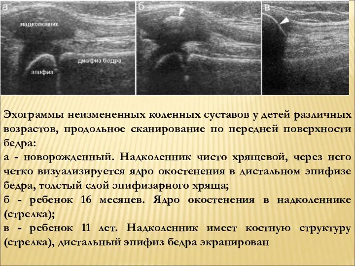 Эхограммы неизмененных коленных суставов у детей различных возрастов, продольное сканирование