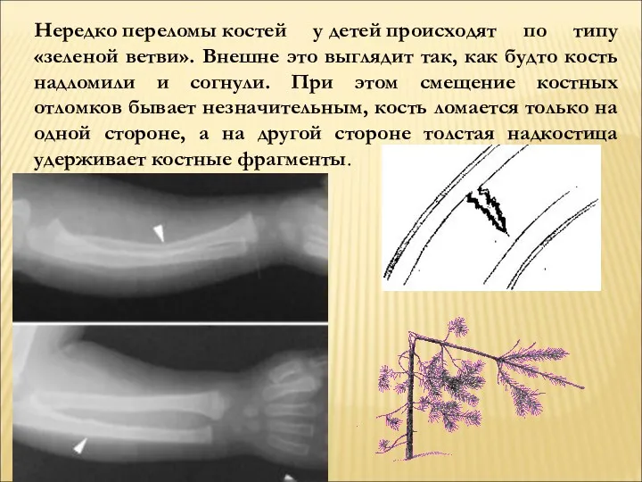 Нередко переломы костей у детей происходят по типу «зеленой ветви».