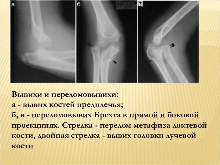 Вывихи и переломовывихи: а - вывих костей предплечья; б, в