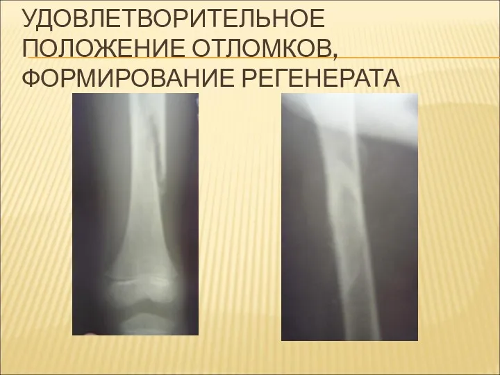 УДОВЛЕТВОРИТЕЛЬНОЕ ПОЛОЖЕНИЕ ОТЛОМКОВ, ФОРМИРОВАНИЕ РЕГЕНЕРАТА