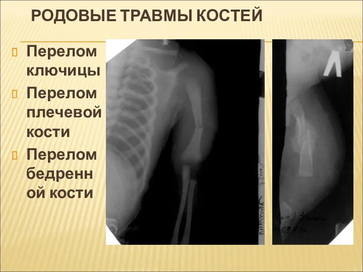 РОДОВЫЕ ТРАВМЫ КОСТЕЙ Перелом ключицы Перелом плечевой кости Перелом бедренной кости