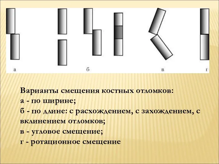 Варианты смещения костных отломков: а - по ширине; б -