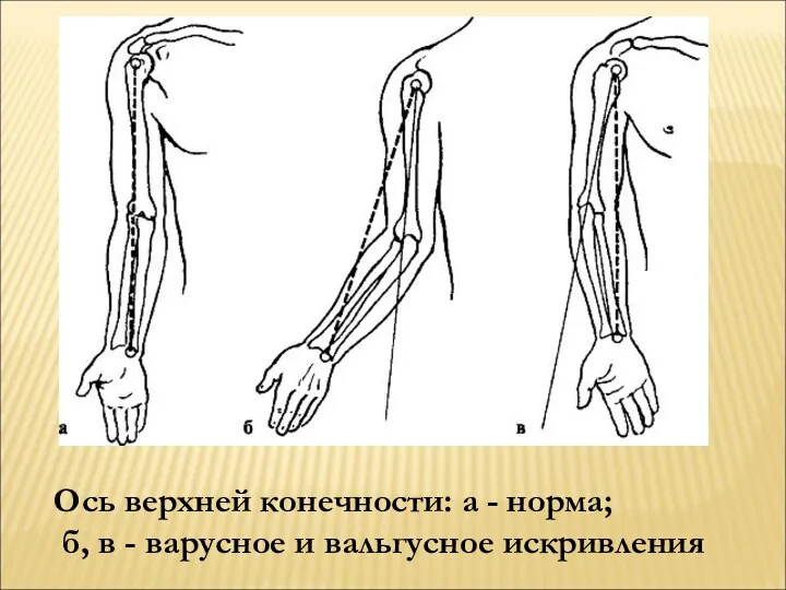 Ось верхней конечности: а - норма; б, в - варусное и вальгусное искривления