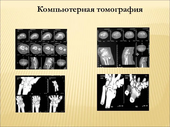 Компьютерная томография