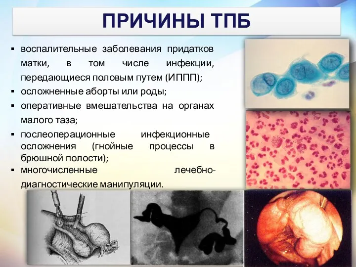 воспалительные заболевания придатков матки, в том числе инфекции, передающиеся половым