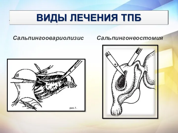 Сальпингоовариолизис Сальпингоовариолизис Сальпингонеостомия