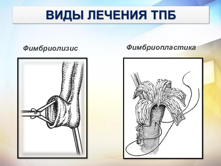 Фимбриолизис Фимбриопластика