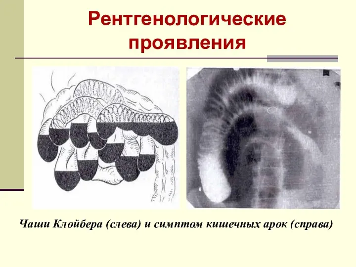 Рентгенологические проявления Чаши Клойбера (слева) и симптом кишечных арок (справа)