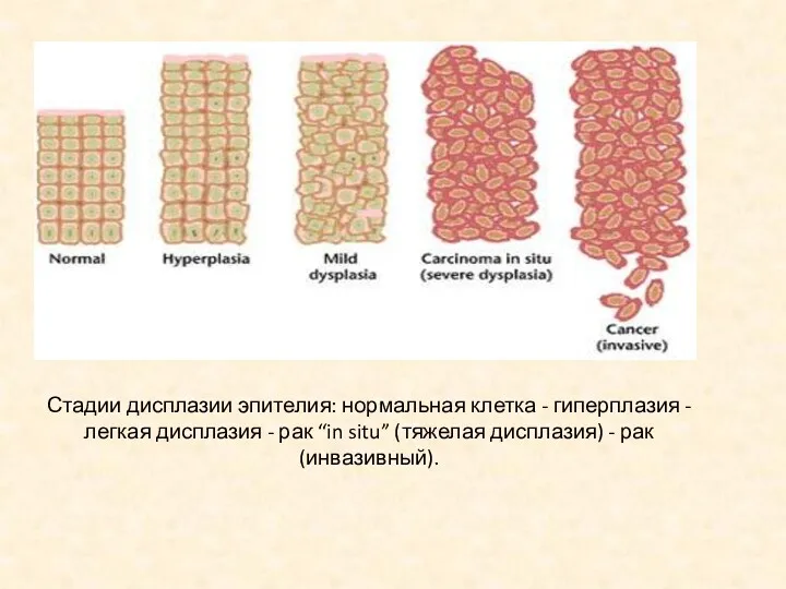 Стадии дисплазии эпителия: нормальная клетка - гиперплазия - легкая дисплазия